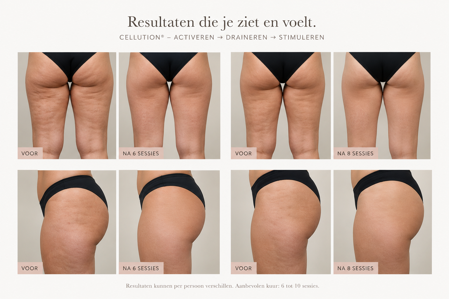 Vergelijking voor en na een Cellution-traject, met een zichtbaar gladder huidbeeld op bil en bovenbeen